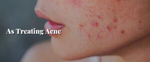 As Treating Acne
