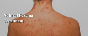 Natural Eczema Treatment