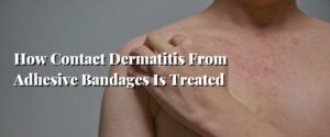 How Contact Dermatitis From Adhesive Bandages Is Treated